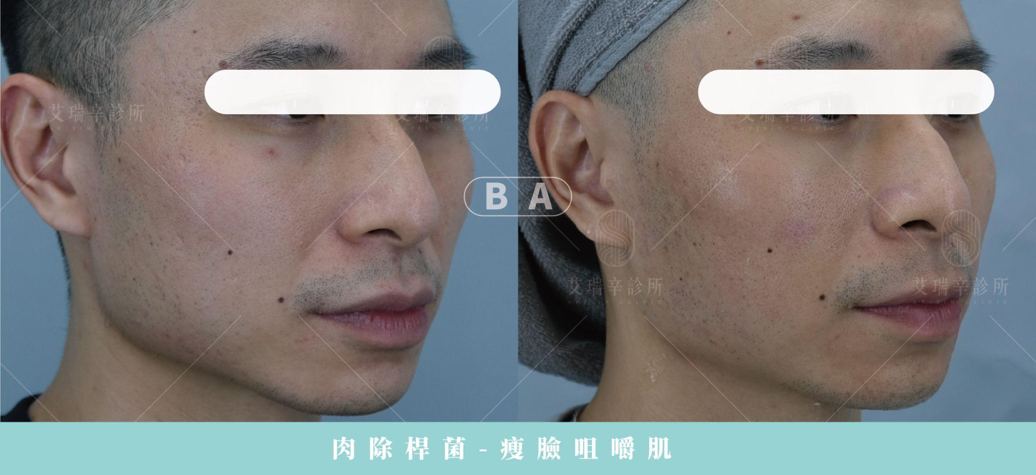 肉毒瘦小臉幾U才夠?咀嚼肌肉毒後遺症與效果全解析 3 艾瑞辛診所肉毒瘦小臉咀嚼肌案例術前術後斜側面對照
