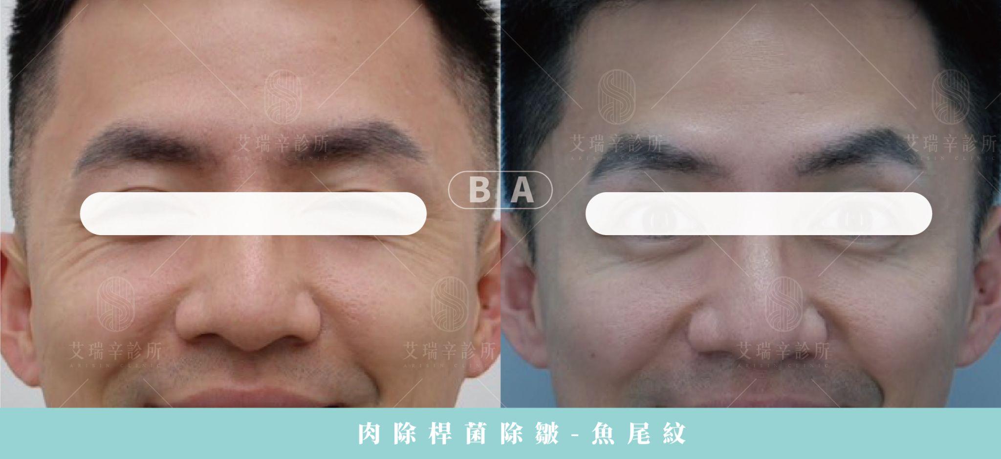 艾瑞辛診所肉毒除皺魚尾紋案例術前術後對照