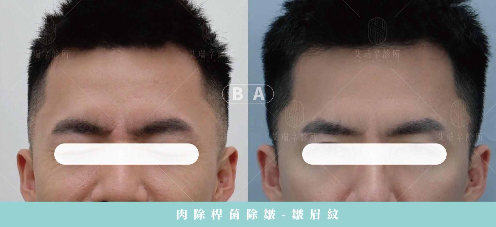 艾瑞辛診所肉毒除皺皺眉紋案例術前術後對照
