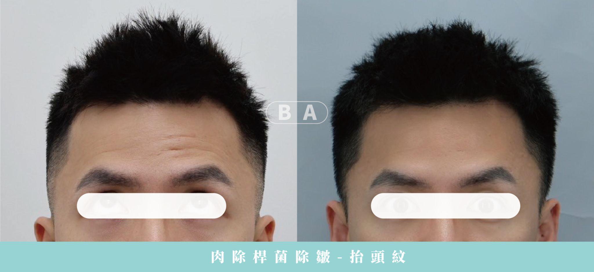 艾瑞辛診所肉毒除皺抬頭紋案例術前術後對照